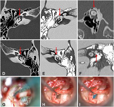 Membranous or Hypermobile Stapes Footplate: A New Anatomic Site Resulting in Third Window Syndrome